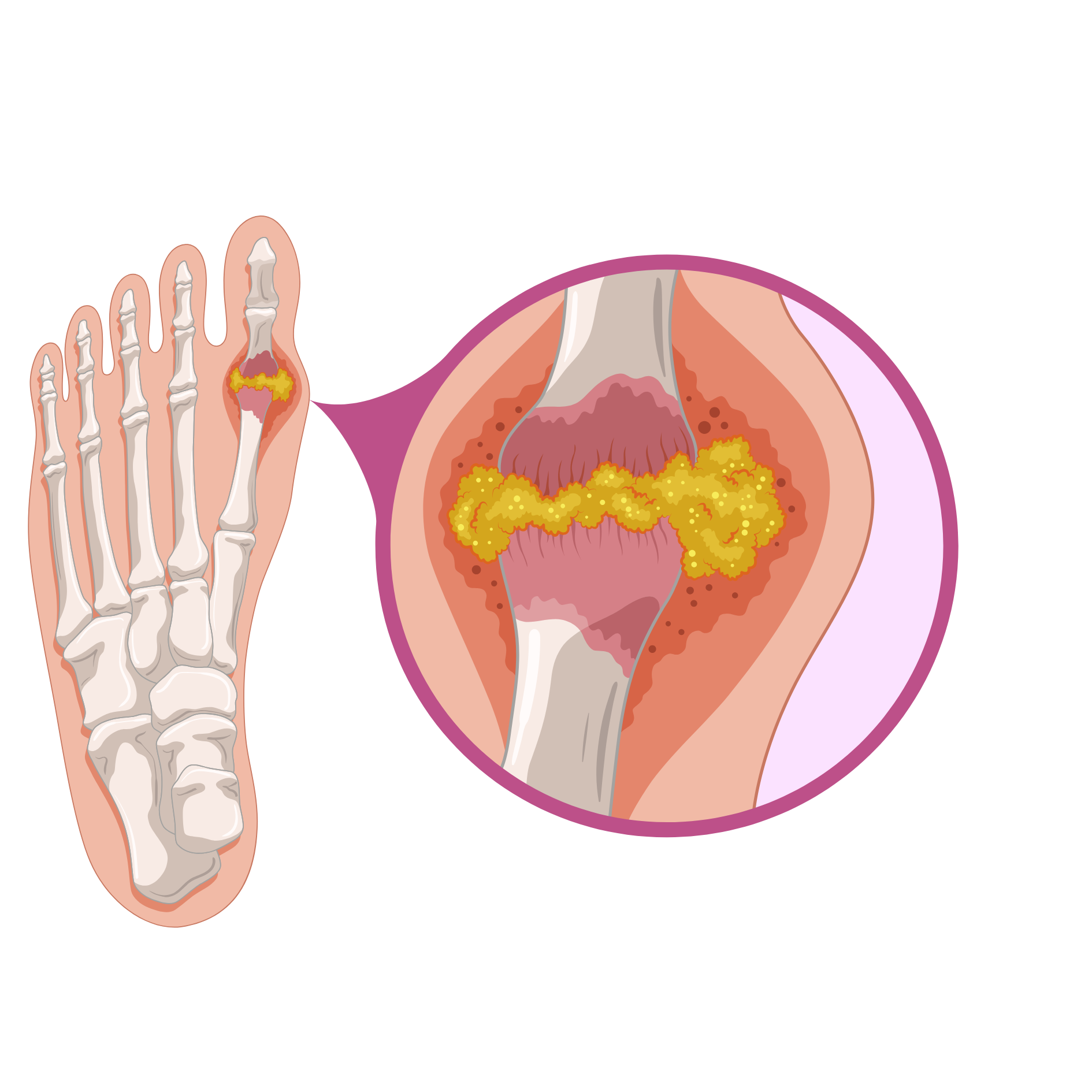 Activated® UA Rx™ Gout Protect